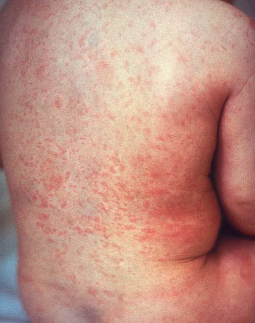 Slideshow: Childhood Rashes Pictures - The Survival Doctor