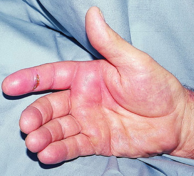 Cellulitis in Adults: Condition, Treatments, and Pictures ...
